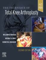 The Technique of Total Knee Arthroplasty